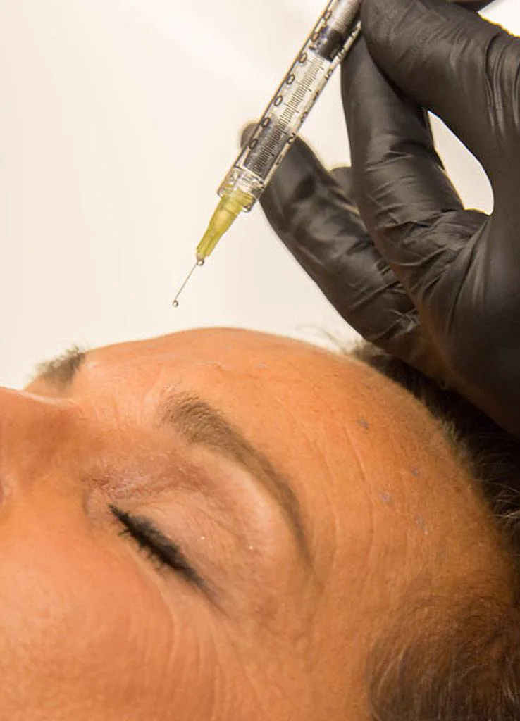 Filler behandeling bij Apotheek&Beauty Monster