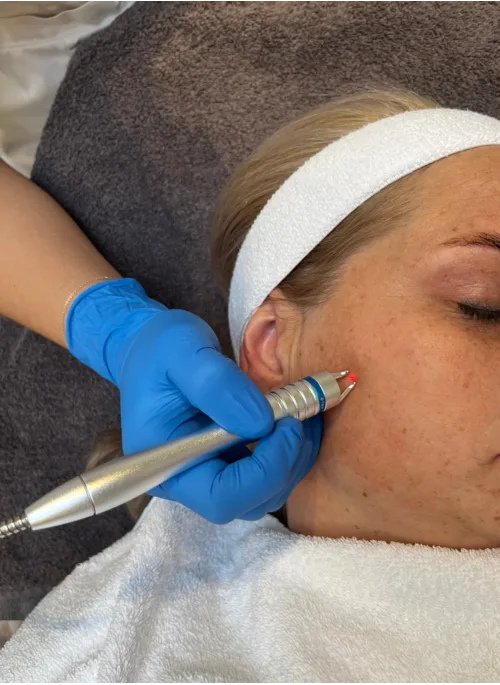Laserbehandeling pigmentvlekken bij Apotheek&Beauty Monster