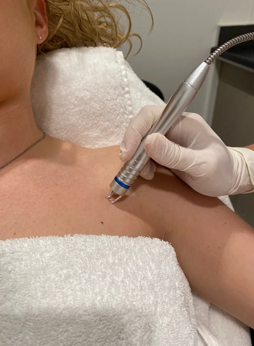 Laserbehandeling rosacea en couperose bij Apotheek&Beauty Monster