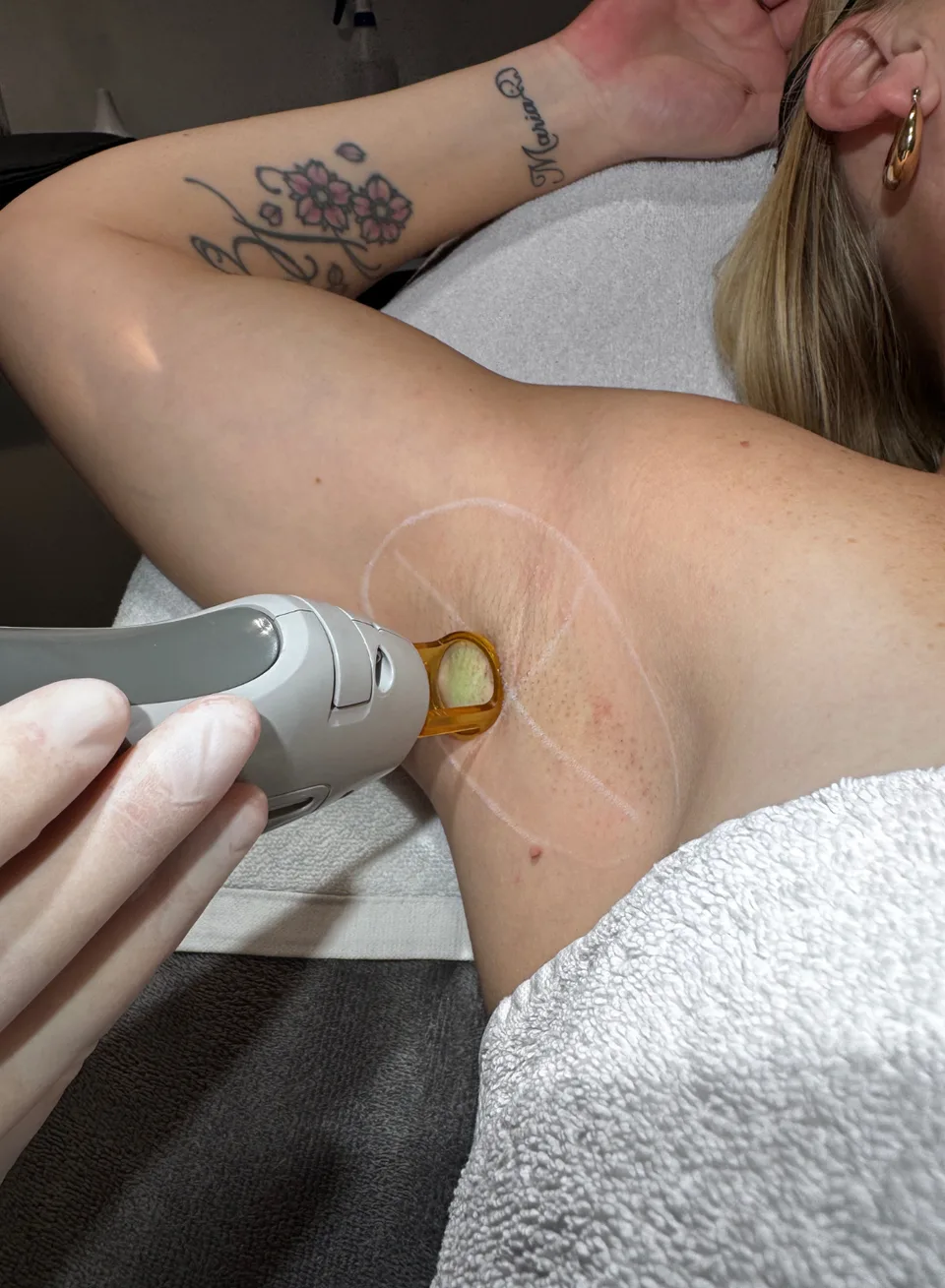 Laserbehandeling definitief ontharen bij Apotheek&Beauty Monster