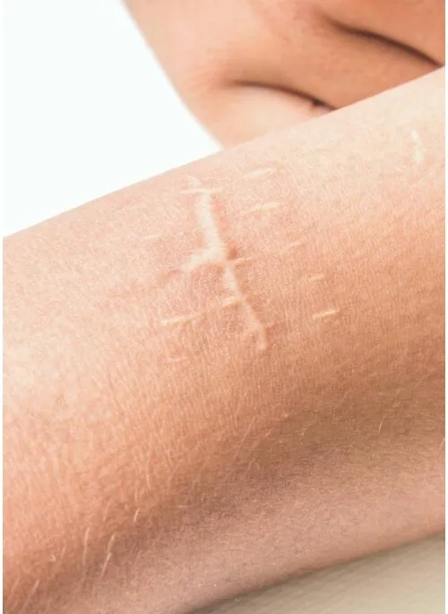 Littekentherapie bij Apotheek&Beauty Monster